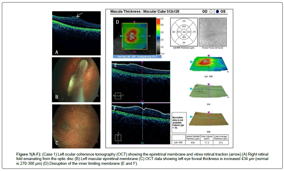 international-journal-ophthalmic-pathology-Left-ocular