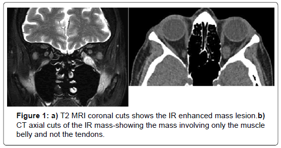 international-journal-ophthalmic-pathology-MRI-coronal