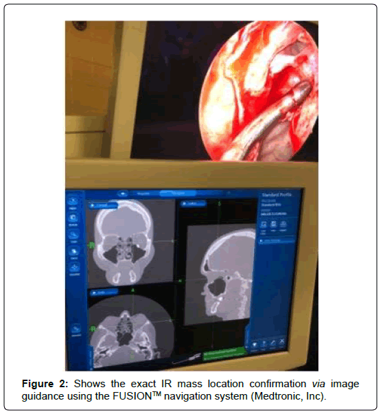 international-journal-ophthalmic-pathology-mass-location