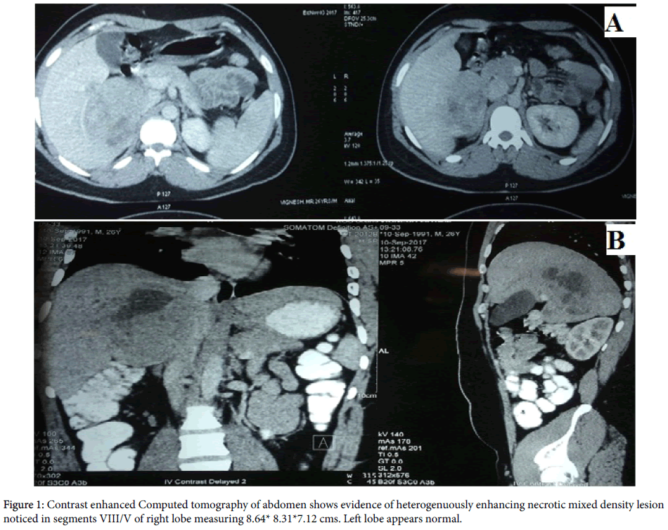 liver-disease-transplantation-Computed-tomography