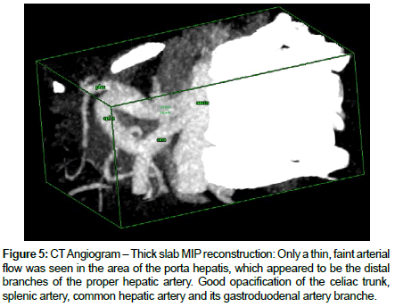 liver-disease-transplantation-Thick-slab