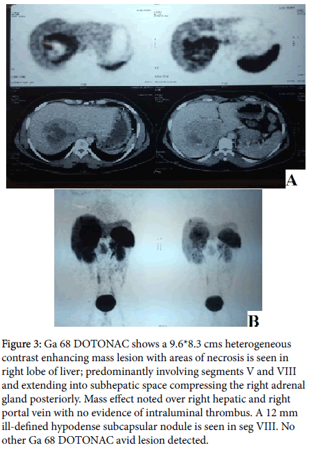 liver-disease-transplantation-mass-lesion