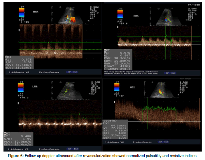 liver-disease-transplantation-revascularization