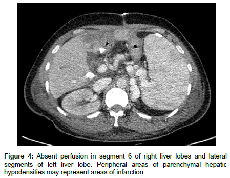 liver-disease-transplantation-right-liver