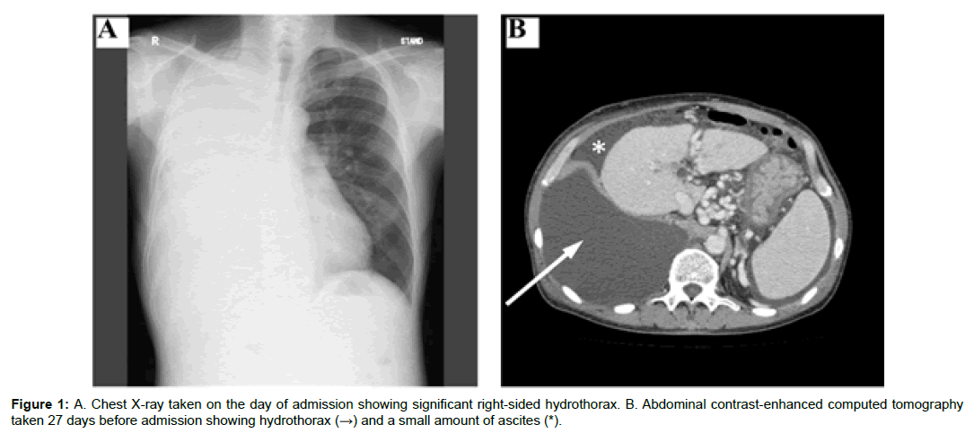 liver-disease-transplantation-right-sided-hydrothorax