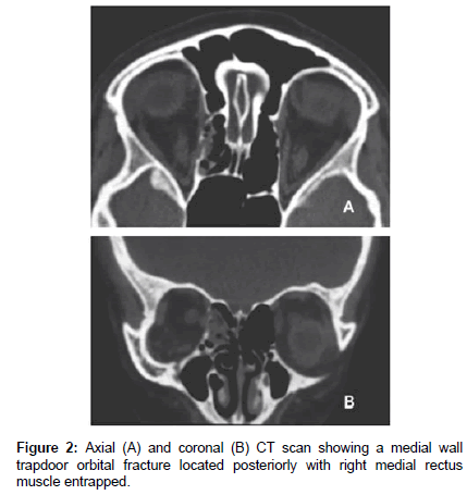 ophthalmic-pathology-CT-scan