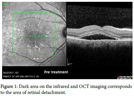 ophthalmic-pathology-Dark-area
