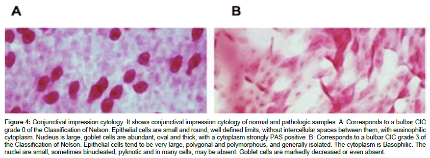 ophthalmic-pathology-Epithelial-cells
