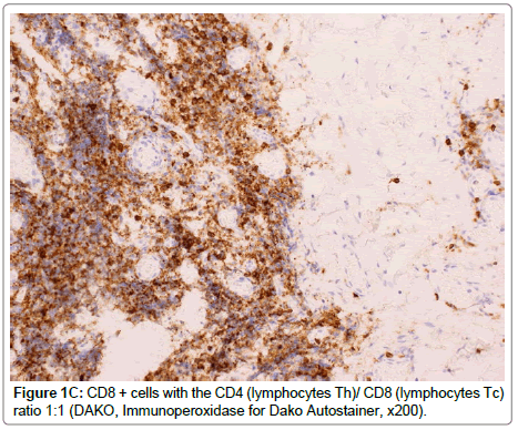 ophthalmic-pathology-Immunoperoxidase