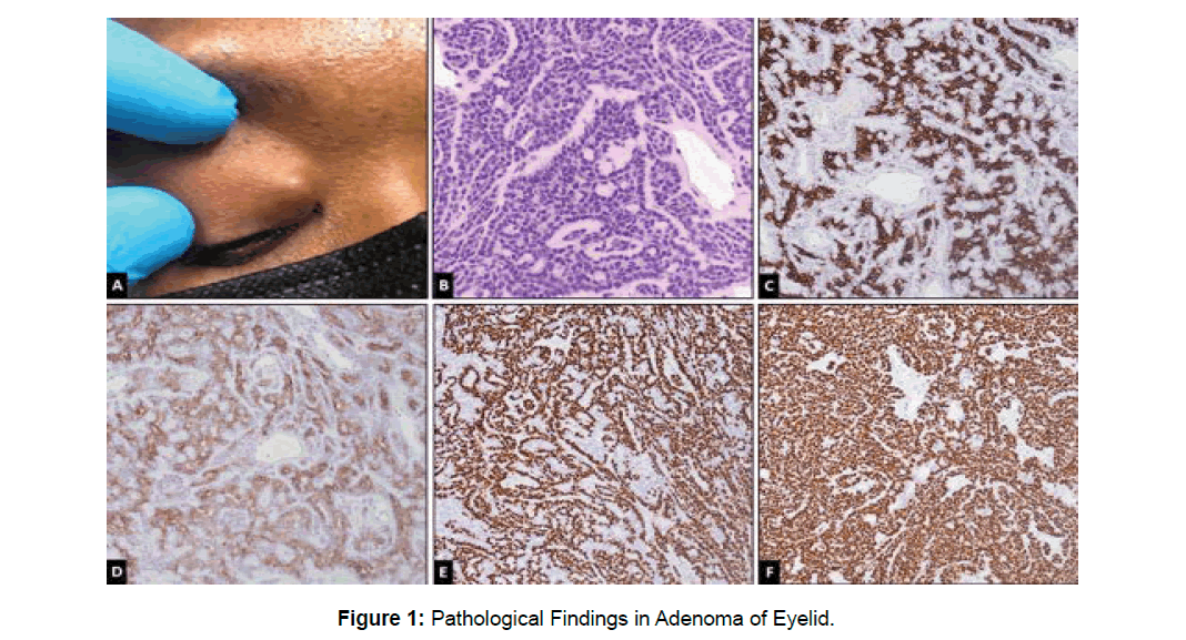 ophthalmic-pathology-adenoma-eyelid