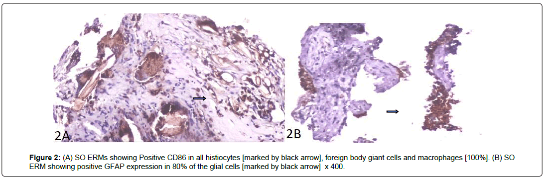 ophthalmic-pathology-glial-cells