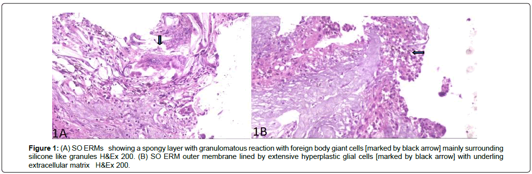 ophthalmic-pathology-granulomatous-reaction