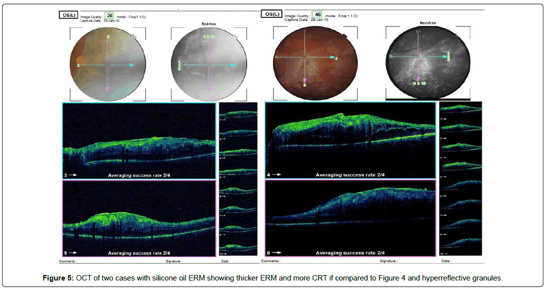 ophthalmic-pathology-hyperreflective-granules