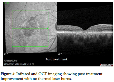 ophthalmic-pathology-laser-burns