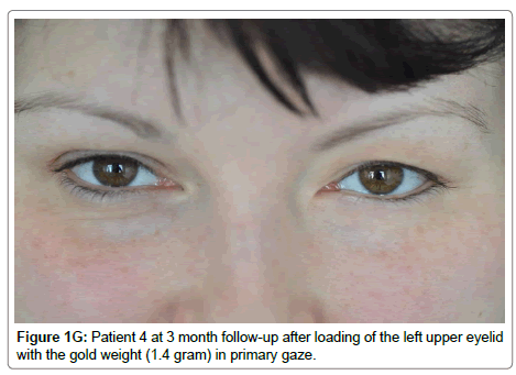 ophthalmic-pathology-left-upper