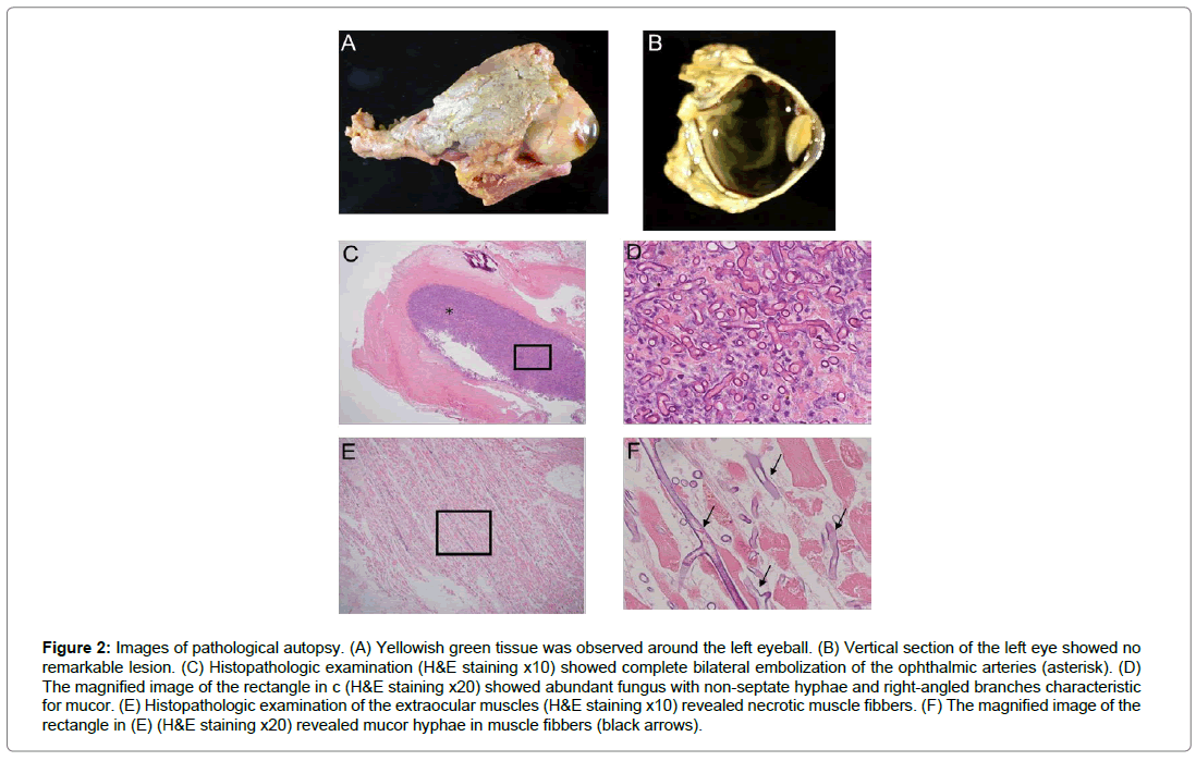 ophthalmic-pathology-pathological-autopsy