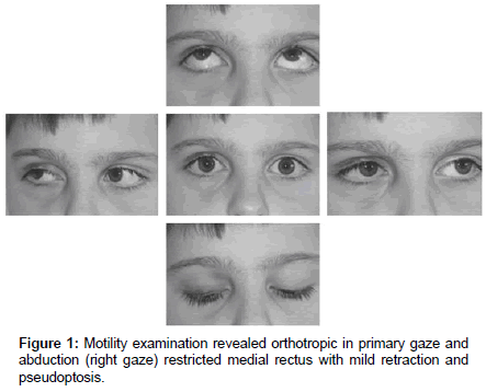 ophthalmic-pathology-right-gaze