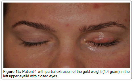 ophthalmic-pathology-upper-eyelid