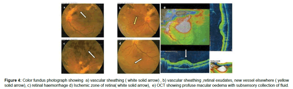 ophthalmic-pathology-vascular-sheathing