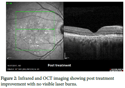 ophthalmic-pathology-visible-laser