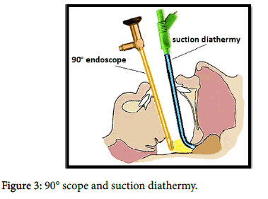 otology-diathermy