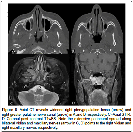 otology-rhinology-Axial-CT