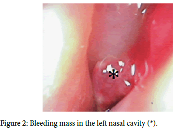 otology-rhinology-Bleeding-mass