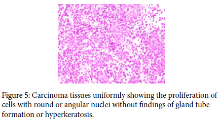 otology-rhinology-Carcinoma-tissues