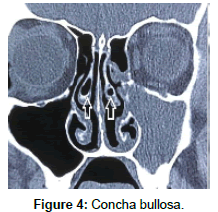 otology-rhinology-Concha-bullosa
