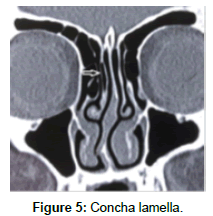 otology-rhinology-Concha-lamella