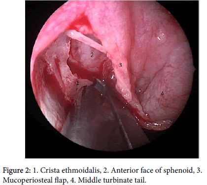 otology-rhinology-Crista-ethmoidalis