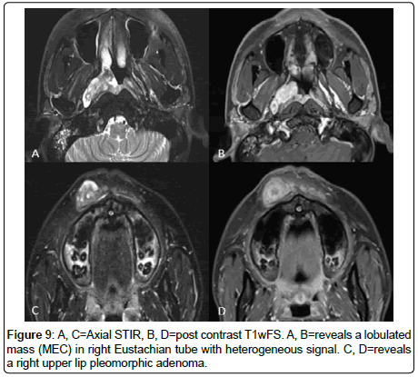 otology-rhinology-Eustachian-tube