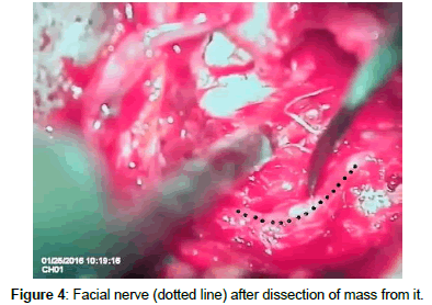 otology-rhinology-Facial-nerve