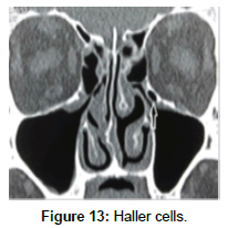 otology-rhinology-Haller-cells