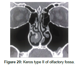otology-rhinology-Keros-type