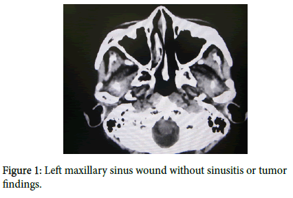 otology-rhinology-Left-maxillary