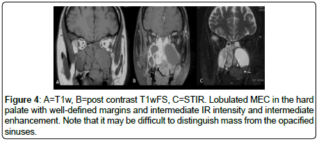 otology-rhinology-Lobulated