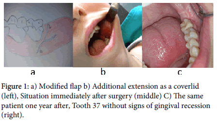 otology-rhinology-Modified-flap