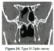 otology-rhinology-Optic