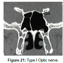 otology-rhinology-Optic-nerve