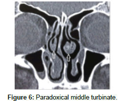 otology-rhinology-Paradoxical-middle