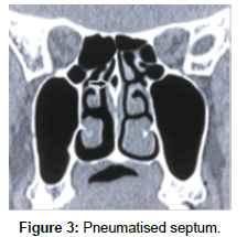 otology-rhinology-Pneumatised-septum