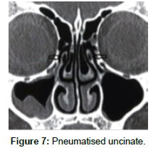 otology-rhinology-Pneumatised-uncinate
