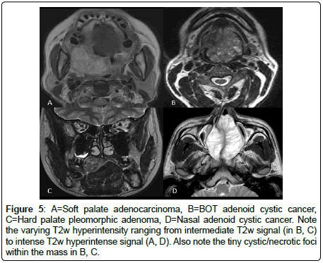 otology-rhinology-Soft-palate