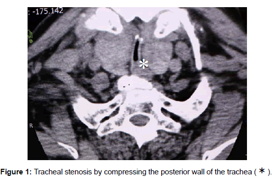 otology-rhinology-Tracheal-stenosis