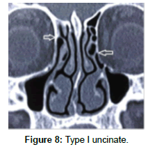 otology-rhinology-Type-uncinate