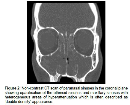 otology-rhinology-coronal-plane