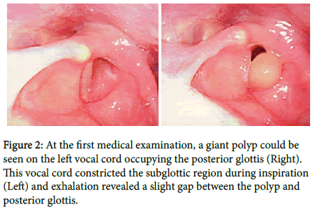 otology-rhinology-giant-polyp