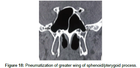 otology-rhinology-greater-wing