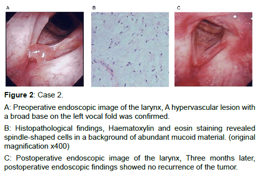 otology-rhinology-hypervascular-lesion
